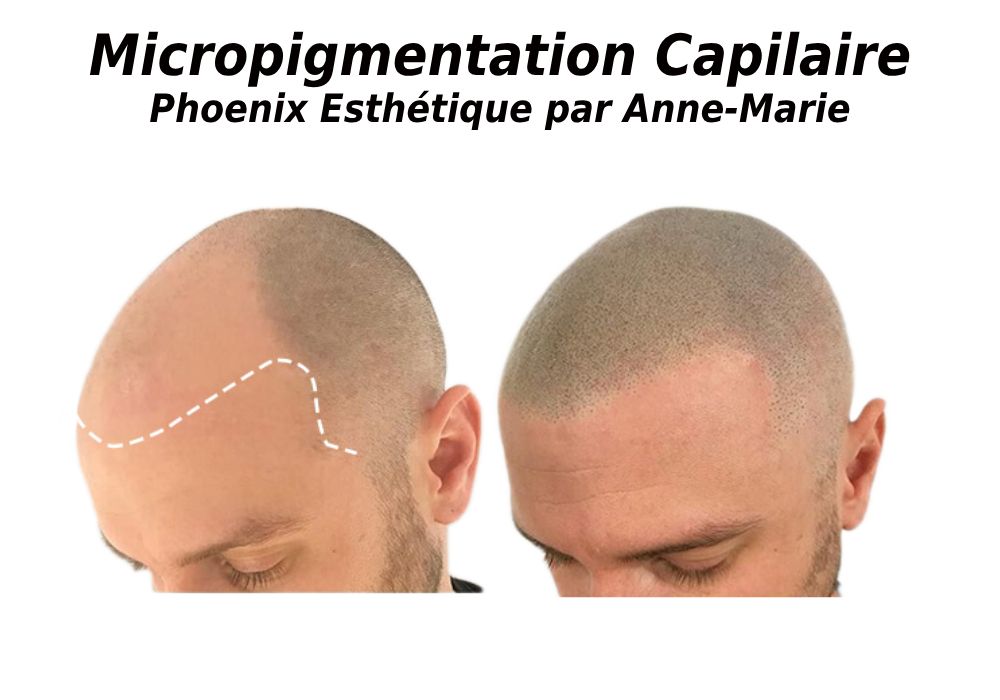 Micropigmentation capillaire à Ste-Foy : prix, séances et retouche